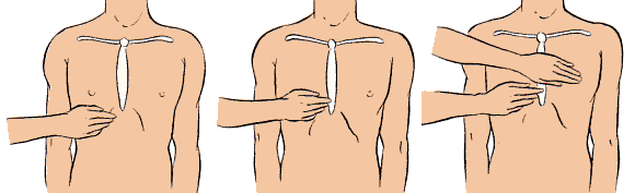 イラスト： 心臓マッサージの手を置く位置